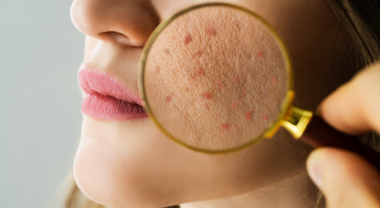 Dermatology